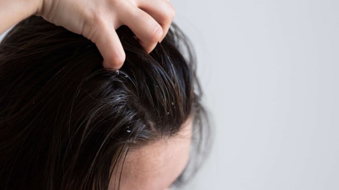 Rahasia Kulit Kepala Sehat: Strategi Ampuh Hilangkan Ketombe dan Tingkatkan Kualitas Rambut