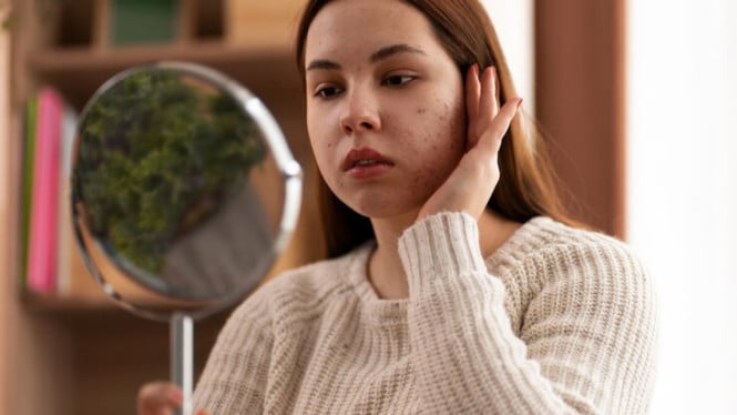 Sunscreen Bukan Musuh Kulit Jerawatan, Ini Bukti Ilmiahnya