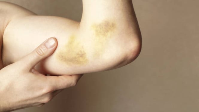 Tubuh Penuh Lebam Tapi Gak Ingat Terbentur? Ini 8 Alasan Mengapa Itu Bisa Terjadi pada Kamu